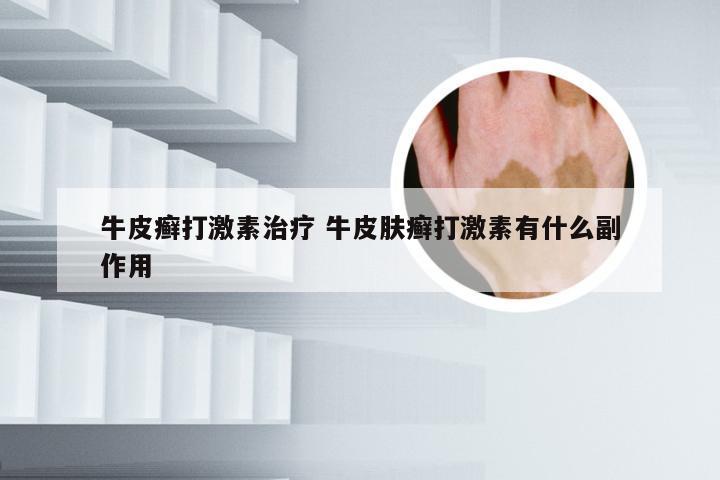 牛皮癣打激素治疗 牛皮肤癣打激素有什么副作用