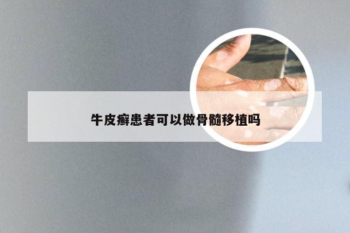 牛皮癣患者可以做骨髓移植吗