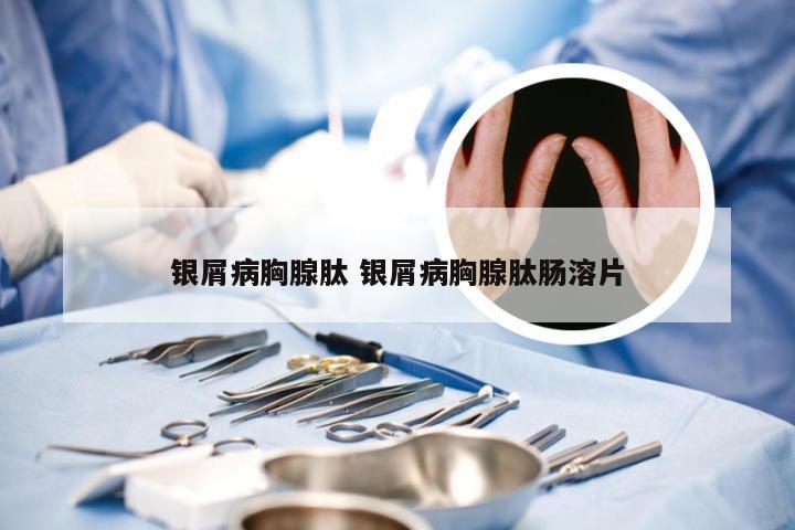 银屑病胸腺肽 银屑病胸腺肽肠溶片