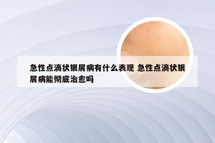 急性点滴状银屑病有什么表现 急性点滴状银屑病能彻底治愈吗