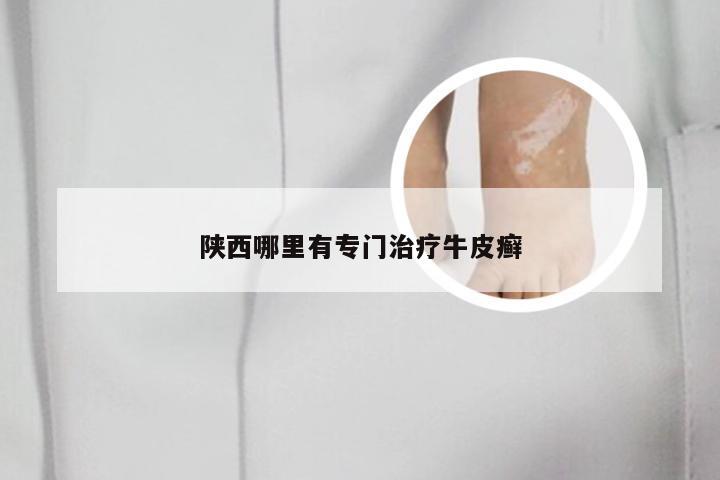 陕西哪里有专门治疗牛皮癣