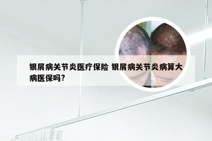 银屑病关节炎医疗保险 银屑病关节炎病算大病医保吗?