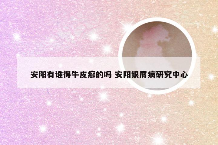 安阳有谁得牛皮癣的吗 安阳银屑病研究中心