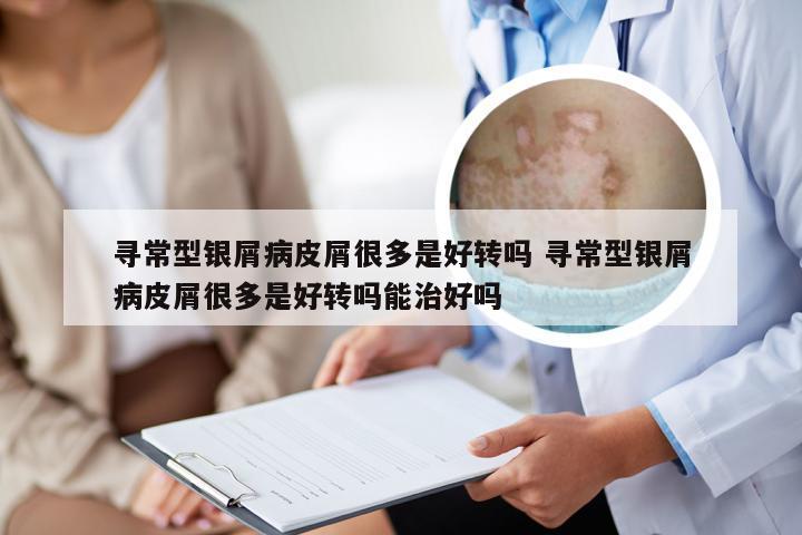寻常型银屑病皮屑很多是好转吗 寻常型银屑病皮屑很多是好转吗能治好吗