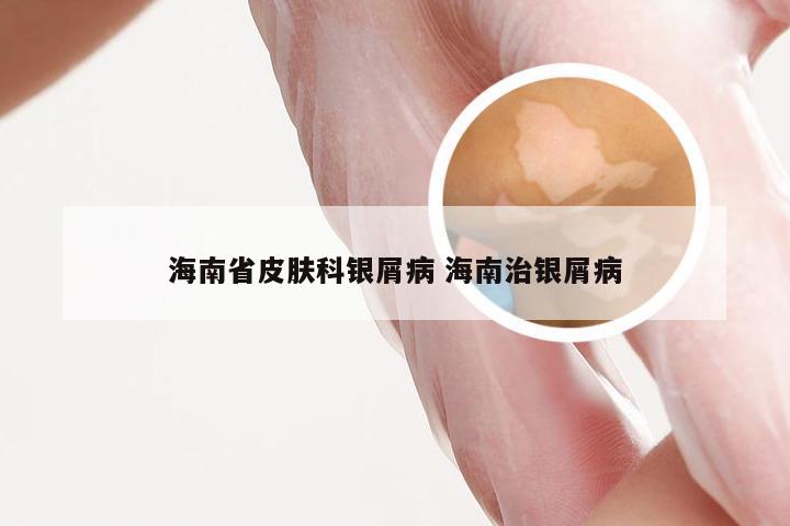 海南省皮肤科银屑病 海南治银屑病