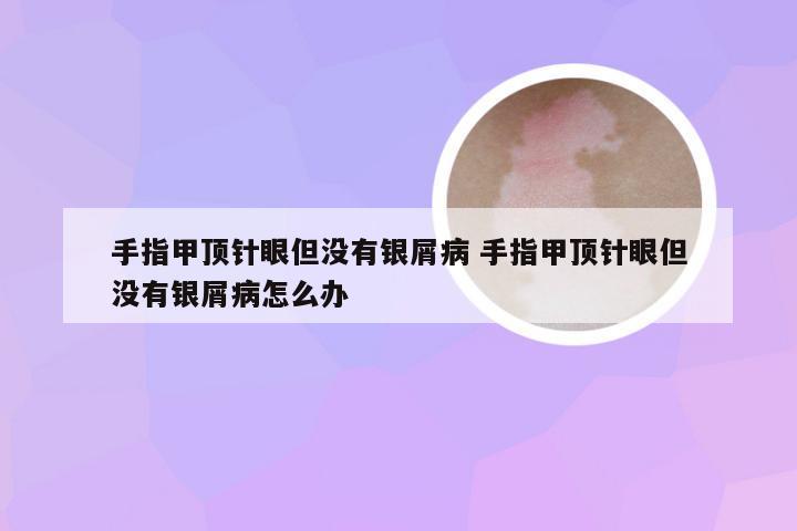 手指甲顶针眼但没有银屑病 手指甲顶针眼但没有银屑病怎么办