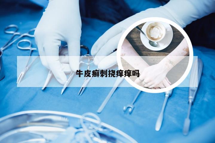 牛皮癣刺挠痒痒吗