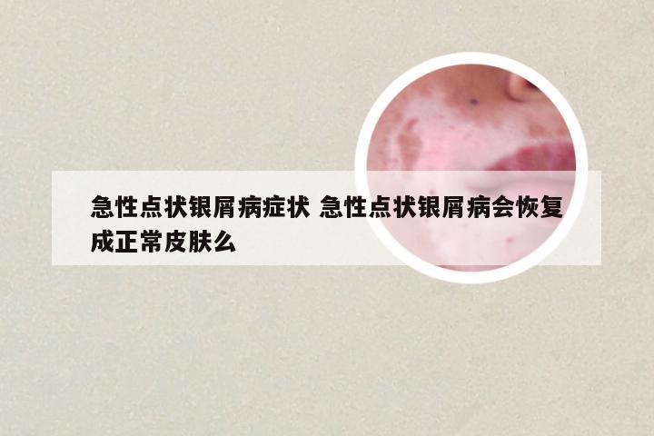 急性点状银屑病症状 急性点状银屑病会恢复成正常皮肤么