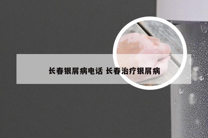 长春银屑病电话 长春治疗银屑病