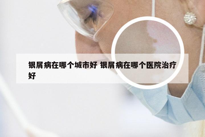 银屑病在哪个城市好 银屑病在哪个医院治疗好