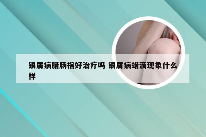 银屑病腊肠指好治疗吗 银屑病蜡滴现象什么样