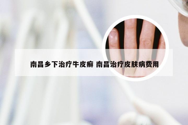 南昌乡下治疗牛皮癣 南昌治疗皮肤病费用