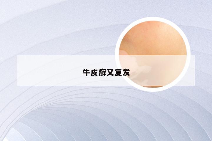 牛皮癣又复发