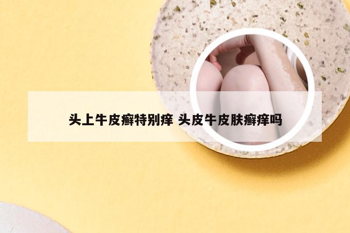 头上牛皮癣特别痒 头皮牛皮肤癣痒吗