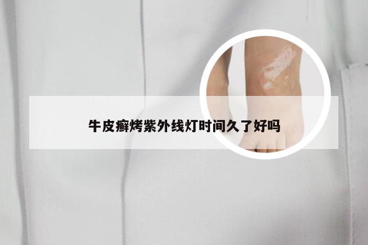 牛皮癣烤紫外线灯时间久了好吗