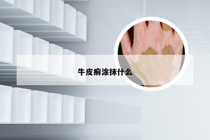 牛皮癣涂抹什么