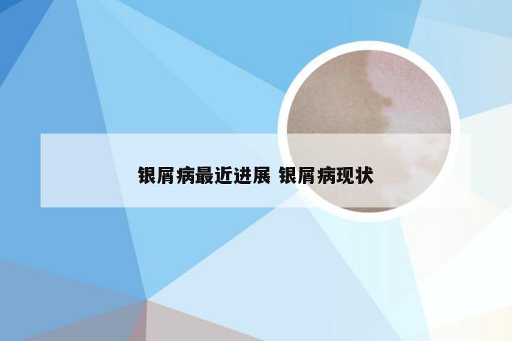 银屑病最近进展 银屑病现状