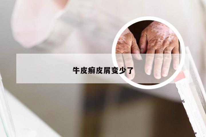 牛皮癣皮屑变少了