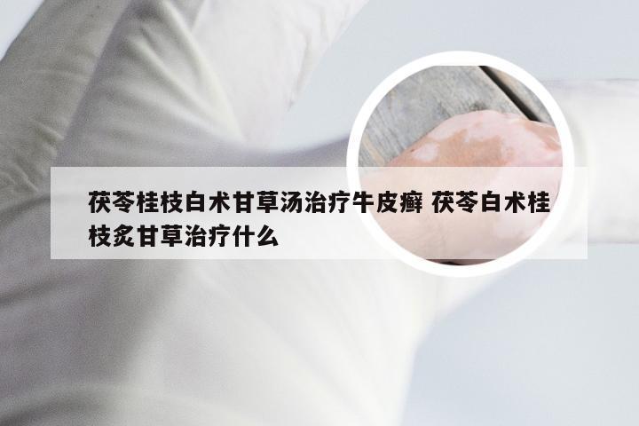 茯苓桂枝白术甘草汤治疗牛皮癣 茯苓白术桂枝炙甘草治疗什么