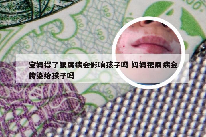 宝妈得了银屑病会影响孩子吗 妈妈银屑病会传染给孩子吗