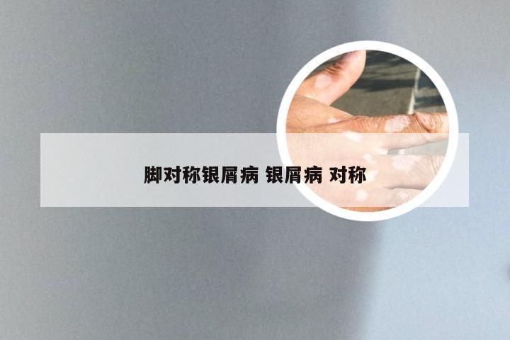 脚对称银屑病 银屑病 对称