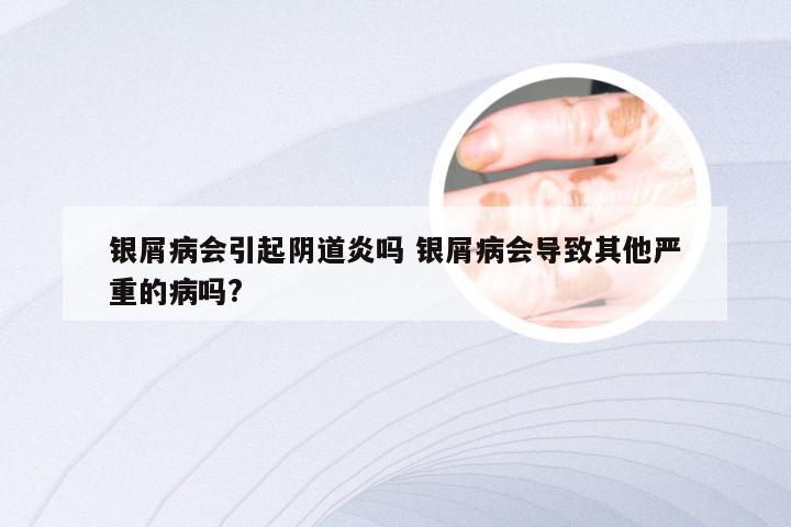 银屑病会引起阴道炎吗 银屑病会导致其他严重的病吗?