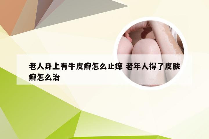 老人身上有牛皮癣怎么止痒 老年人得了皮肤癣怎么治
