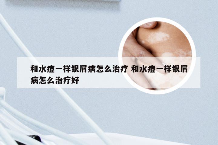 和水痘一样银屑病怎么治疗 和水痘一样银屑病怎么治疗好