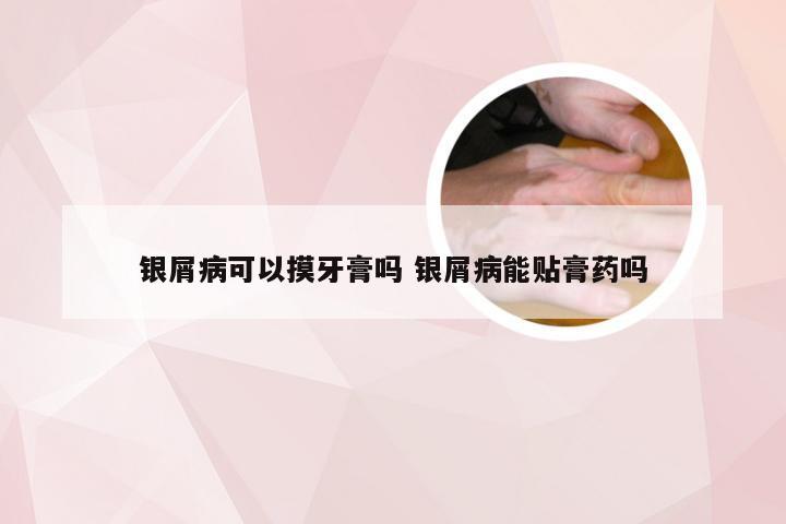 银屑病可以摸牙膏吗 银屑病能贴膏药吗