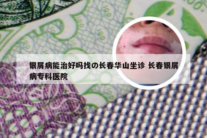 银屑病能治好吗找の长春华山坐诊 长春银屑病专科医院
