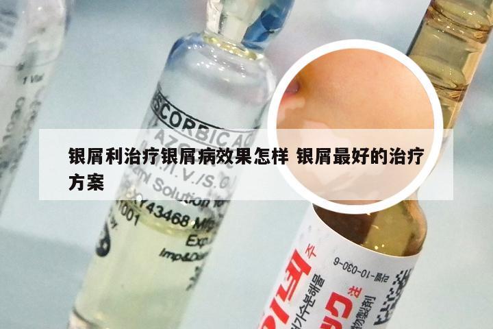 银屑利治疗银屑病效果怎样 银屑最好的治疗方案