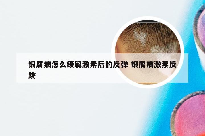 银屑病怎么缓解激素后的反弹 银屑病激素反跳