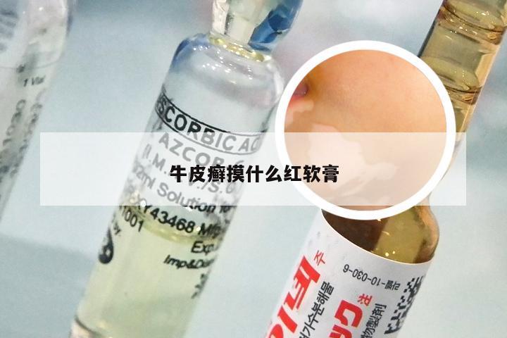 牛皮癣摸什么红软膏