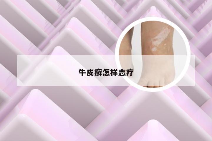 牛皮癣怎样志疗