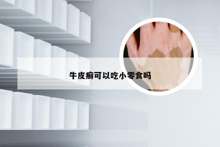 牛皮癣可以吃小零食吗