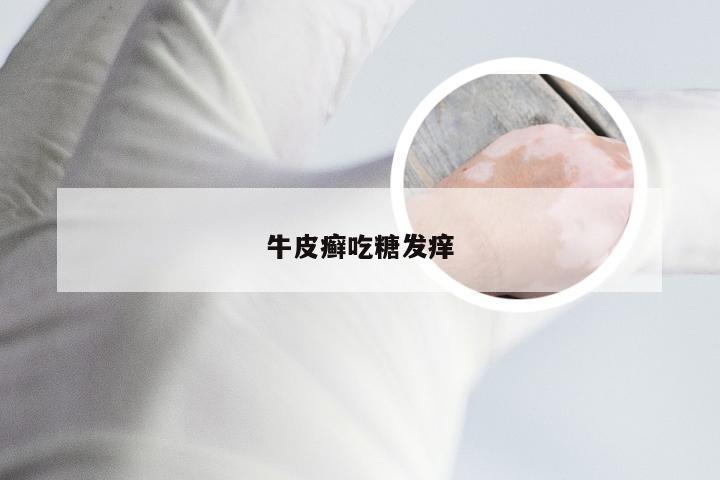 牛皮癣吃糖发痒