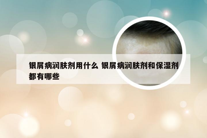 银屑病润肤剂用什么 银屑病润肤剂和保湿剂都有哪些