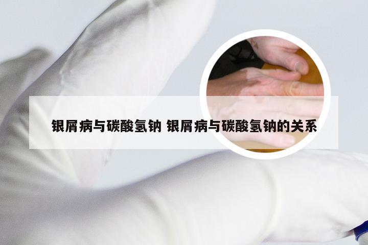 银屑病与碳酸氢钠 银屑病与碳酸氢钠的关系