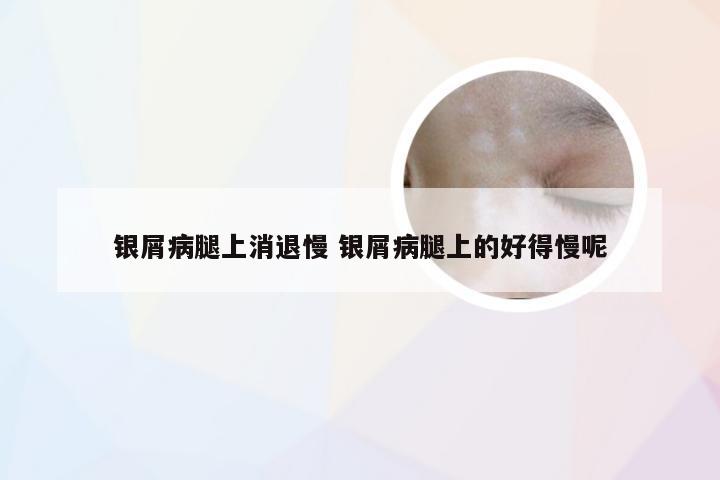 银屑病腿上消退慢 银屑病腿上的好得慢呢