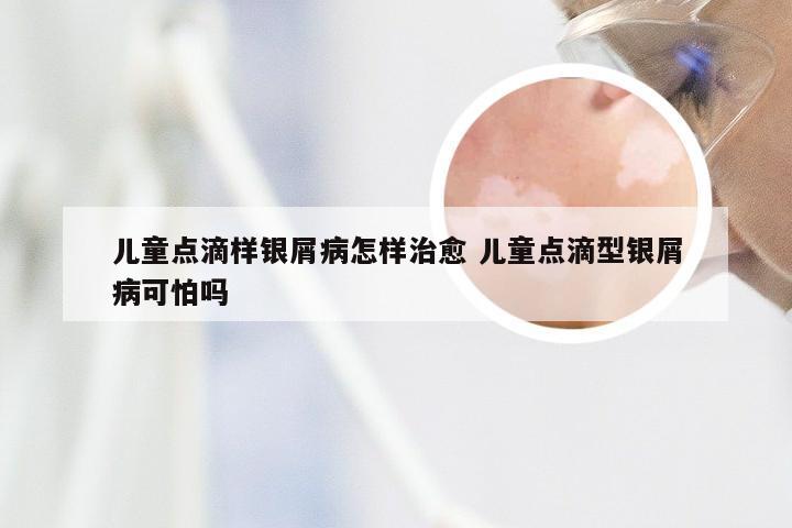 儿童点滴样银屑病怎样治愈 儿童点滴型银屑病可怕吗