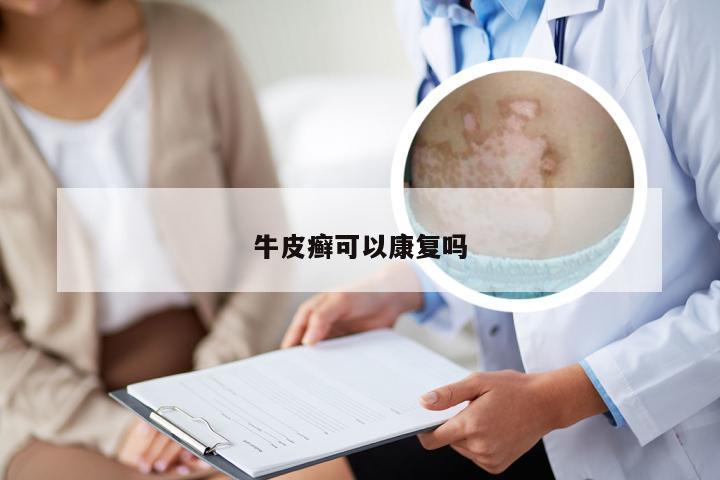 牛皮癣可以康复吗