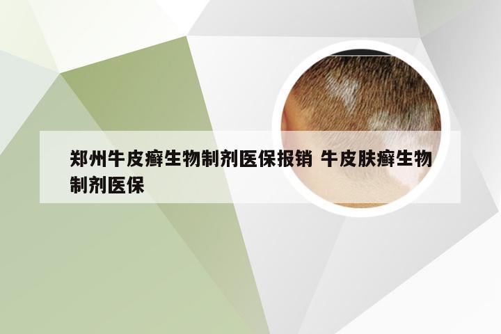 郑州牛皮癣生物制剂医保报销 牛皮肤癣生物制剂医保