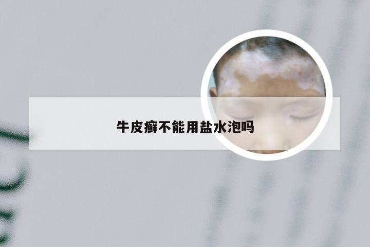 牛皮癣不能用盐水泡吗