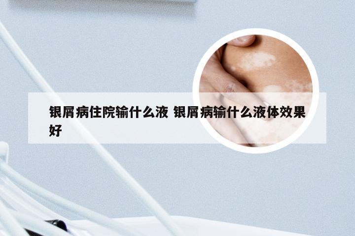 银屑病住院输什么液 银屑病输什么液体效果好