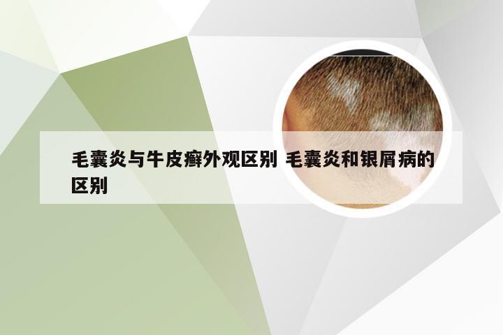 毛囊炎与牛皮癣外观区别 毛囊炎和银屑病的区别