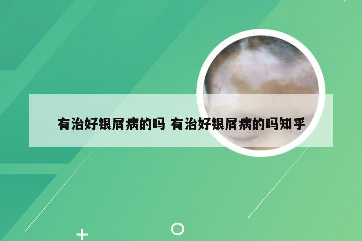 有治好银屑病的吗 有治好银屑病的吗知乎