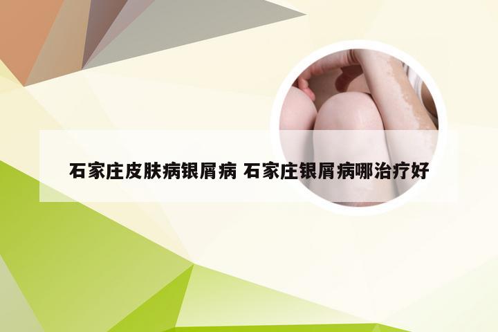 石家庄皮肤病银屑病 石家庄银屑病哪治疗好