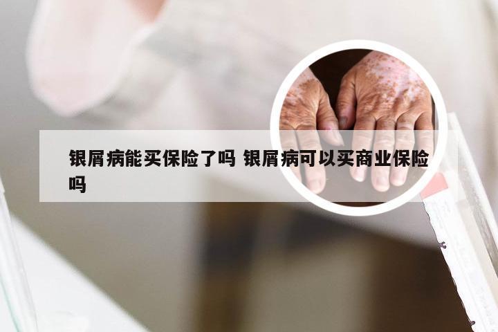 银屑病能买保险了吗 银屑病可以买商业保险吗
