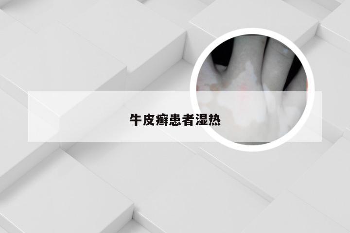 牛皮癣患者湿热