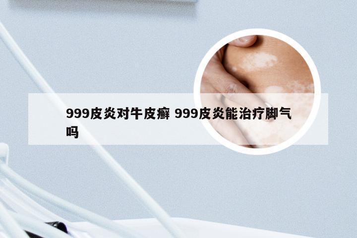 999皮炎对牛皮癣 999皮炎能治疗脚气吗